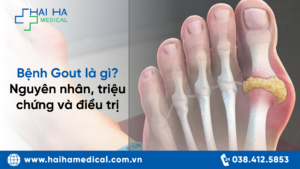 Bệnh Gout là gì? Nguyên nhân, triệu chứng và điều trị