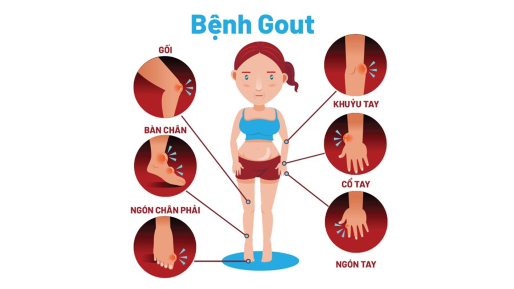 Nguyên nhân bệnh Gout?