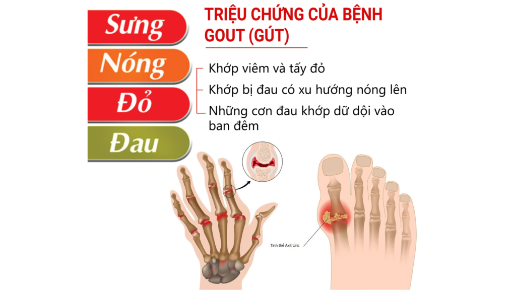 triệu chứng bệnh gout