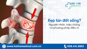 Xẹp lún đốt sống là gì